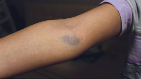 Gambar Tangan Bekas Ambil Darah