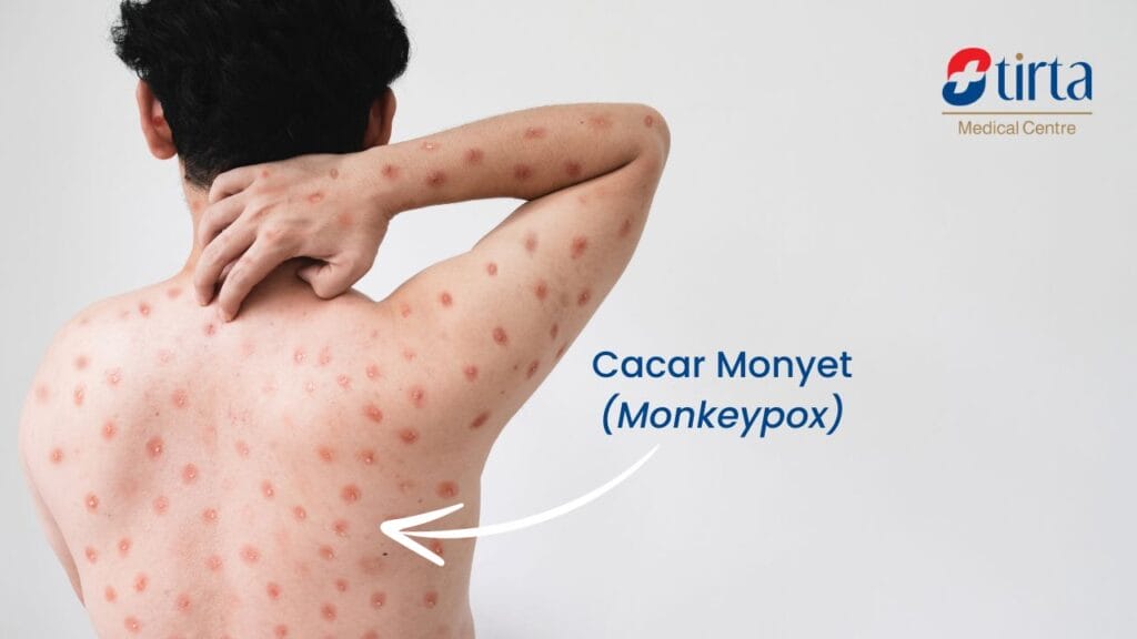 Monkeypox: Symptoms, Causes, and Treatment