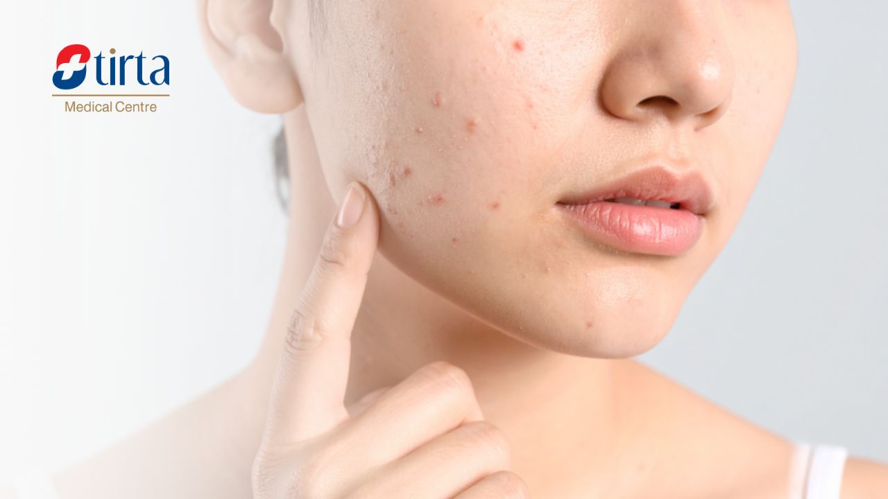 Cara Menghilangkan Jerawat