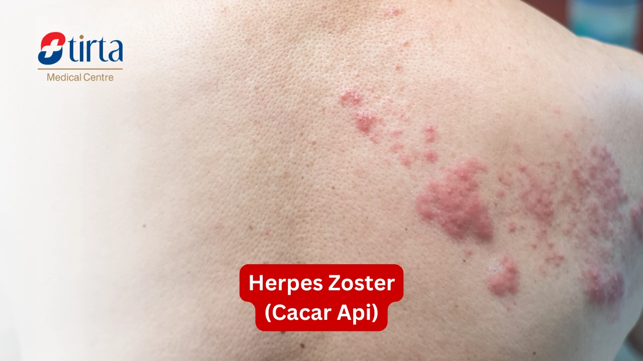 Herpes Zoster