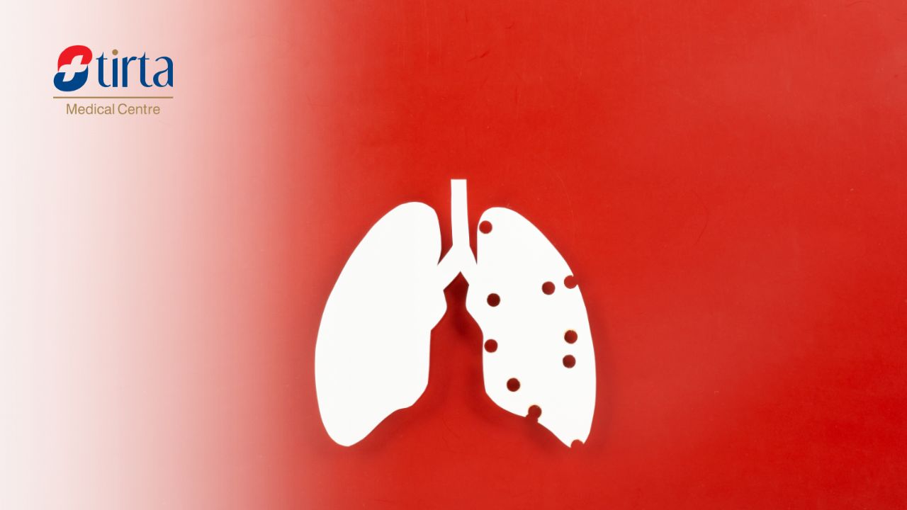 Cara Penularan TBC (Tuberkulosis)