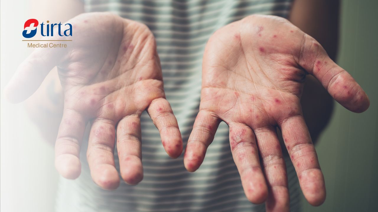 Campak pada Orang Dewasa