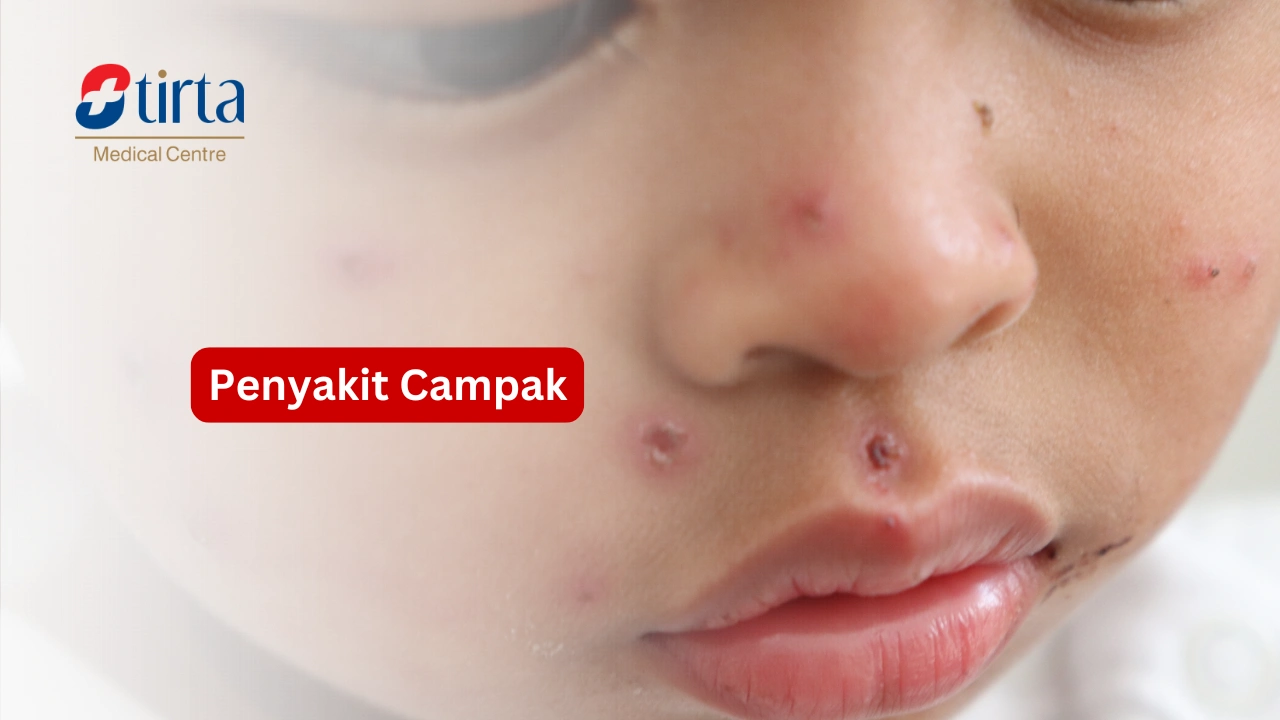 Penyakit Campak